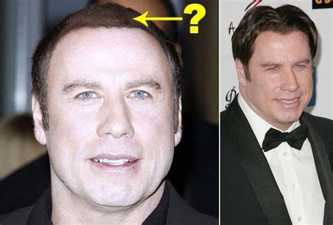 John Travolta’s Botox and Facelift